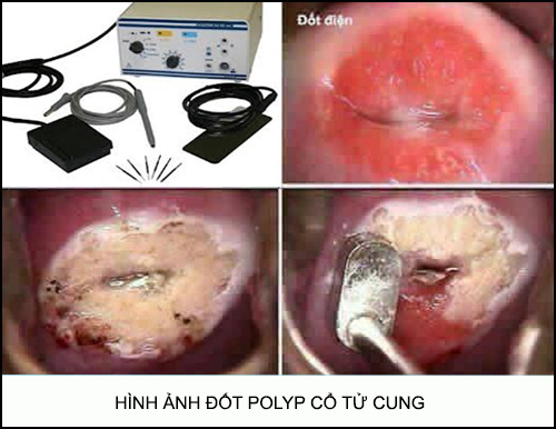 Đốt polyp cổ tử cung có đau không - hình ảnh đốt polyp