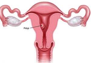 Polyp cổ tử cung là bệnh gì?