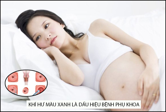 ra khí hư màu xanh khi mang thai là dấu hiệu bệnh lý phụ khoa